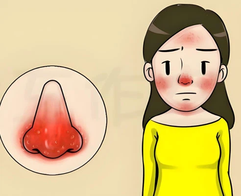 Ivermectin cream | Shaanxi BLOOM Tech Co., Ltd Ivermectin cream | Shaanxi BLOOM Tech Co., Ltd